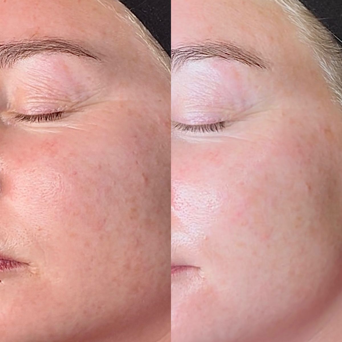 Skin treatment — before and after